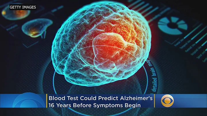 Blood Test Could Detect Alzheimer's Up To 16 Years Before Symptoms Begin, Study Says