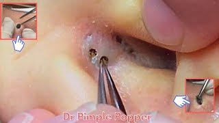 Treatment of Blackheads and Hidden Acne 003 / dr pimple popper