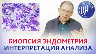 видео: Биопсия эндометрия: интерпретация анализа. Клетки-киллеры матки и хронический эндометрит. Гузов И.И. картинка: Биопсия эндометрия: интерпретация анализа. Клетки-киллеры матки и хронический эндометрит. Гузов И.И.