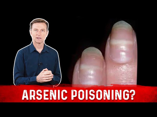 Arsenic and Leukonychia | Prescription For Murder