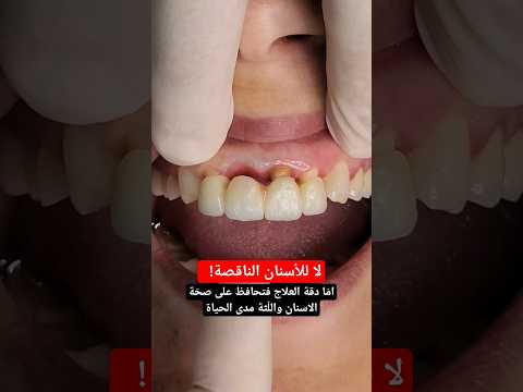 جسر وتلبيسات زيركون