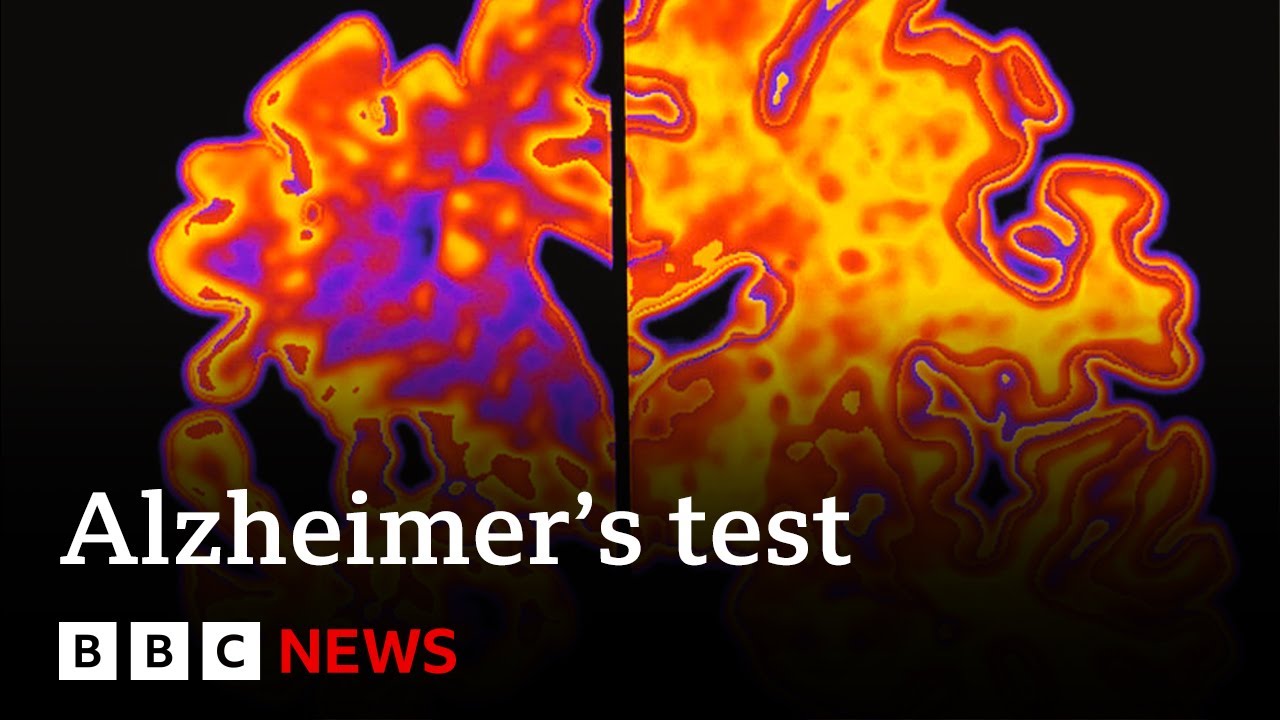 Blood test may revolutionise treatment of Alzheimers disease | BBC News