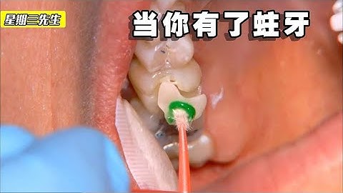 探訪國外牙科，看似簡單的補牙過程，其實並不簡單 - 天天要聞