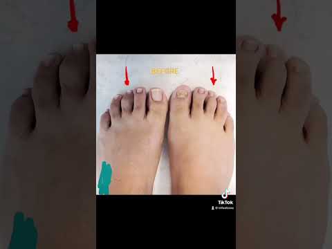 Video: Este inclusă tenotomia flexorului în repararea degetului în ciocan?