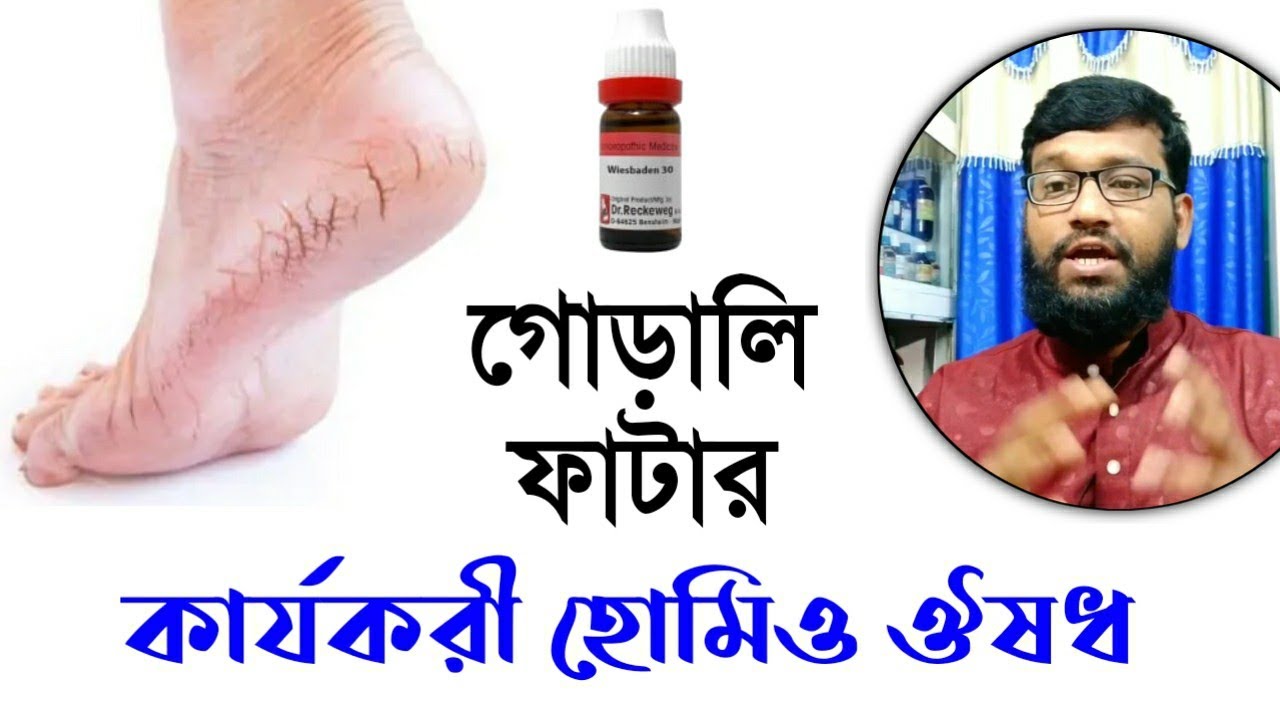 পায়ের তলা ফাটা আর গোড়ালি ফাটার হোমিও ঔষধ | crack heel & feet homeopathy medicine