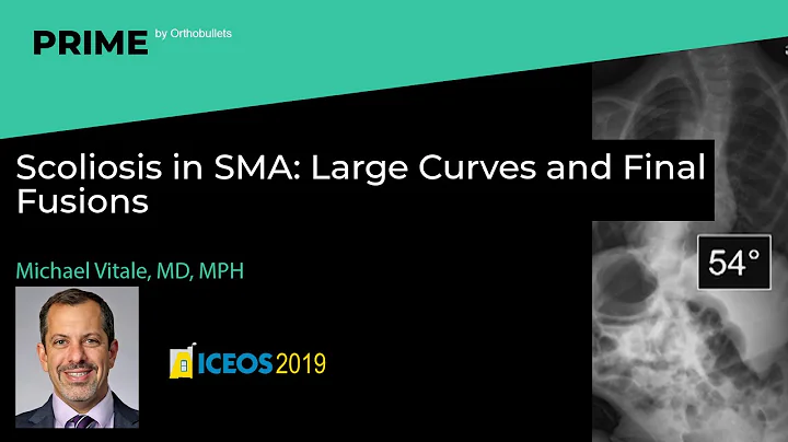 Scoliosis in SMA: Large Curves and Final Fusions -...