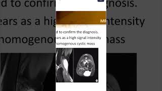 popliteal cyst/baker cyst details notes and follow for more informative content#physiotherapy popliteal cyst/baker cyst details notes and follow for more informative content#physiotherapy