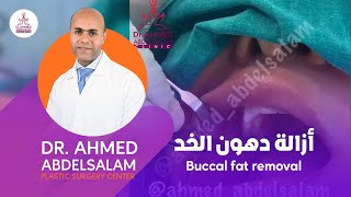 أزاله دهون الخد buccal fat removal