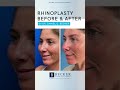 Rhinoplasty One Year Later | Dr. Becker 👃🤩