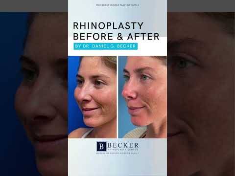 Video thumbnail: Rhinoplasty One Year Later | Dr. Becker 👃🤩 · Becker Rhinoplasty Center