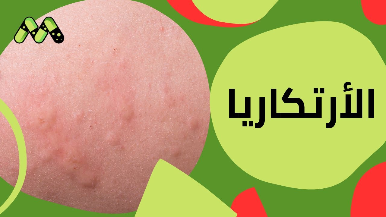 الأرتكاريا في فصل الشتاء أسبابها وأعراضها وطرق العلاج مع د. أمجد الحداد