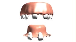 Partial Dentures