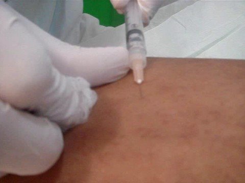 Du plan de la sortie du patient avec la phlébite aiguë