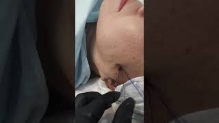 Видео Лифтинг пдо нитями. Тяжелое лицо. (автор: Dr, Samadi Olga)