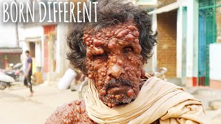 The Man With 1000 Tumours | BORN DIFFERENT