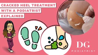 Cracked heel treatment with a Podiatrist | Cracked heels series | The Foot Scraper: DG Podiatrist