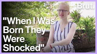 Indian Woman With Albinism Talks About Life at School and Work
