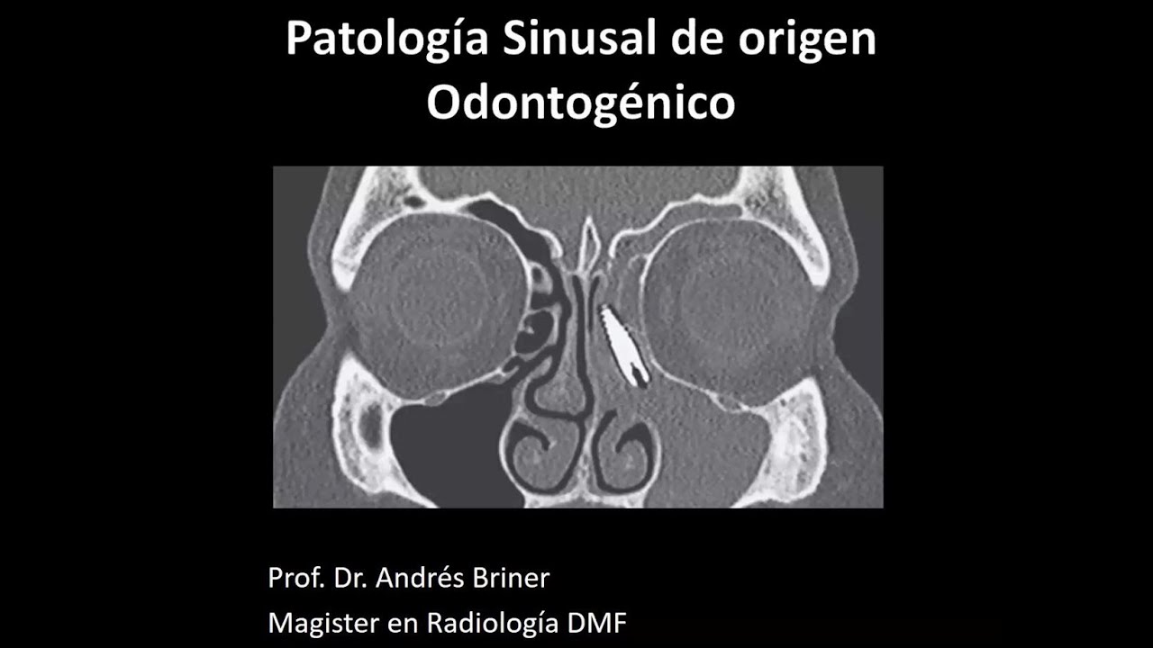 Patología sinusal de origen Odontogénico