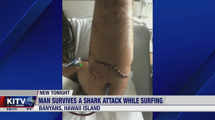 Kona man lucky to be alive after he says a shark bit him while surfing over the weekend.