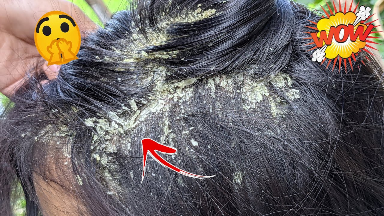 Dandruff Removal Itchy Dry Scalps Psoriasis Treatment Huge Flakes