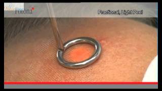 Peeling Laserowy Delikatny