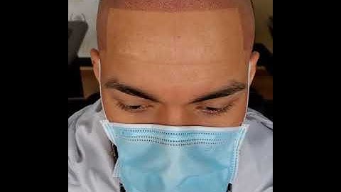 Scalp Micropigmentation before and after