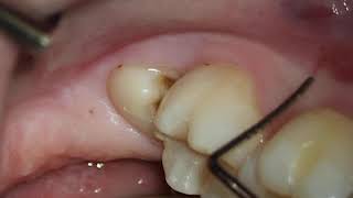 ⁣Wisdom tooth surgical removal, step by step