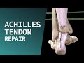 Achilles Tendon Repair