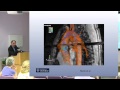 New approaches to Marfan syndrome - Alex Pitcher