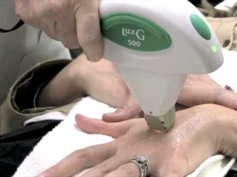 LASER HAND REJUVENATION Hada Cosmetic Medicine