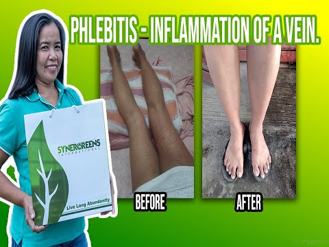 INFLAMMATION OF A VEIN OR PHLEBITIS CURED BY SYNERGREENS?