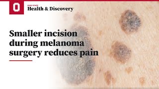 Smaller incision during melanoma surgery reduces pain | Ohio State Medical Center