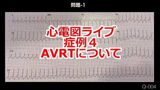 【心電図】心電図ライブ！第４症例　AVRTについて