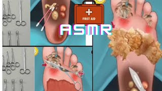 ASMR  Leg foot pain treatment  Remove dead skin and plantar