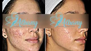Skin Tightening Results At Albany Laser Clinic