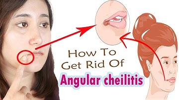 Say Goodbye to Painful Mouth Cracks – Angular Cheilitis Treatment!