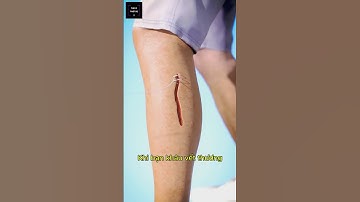 Mũi khâu bao lâu thì cắt chỉ? #shorts #video