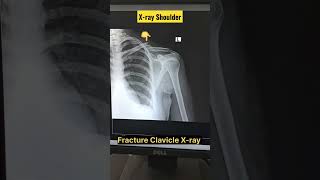 Clavicle Fracture X-ray | X-ray Shoulder #shorts #radiography #fracture #radiology #xray #clavicle