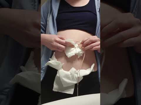 Video: Införing Av Matningsrör (gastrostomi)