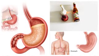 علاج حرقان المعدة