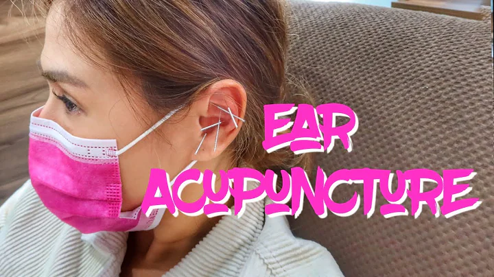 EAR (AURICULAR) ACUPUNCTURE TO REDUCE STRESS AND D...