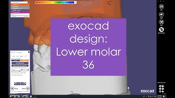 Exocad: lower molar 36 (in 5 minutes)