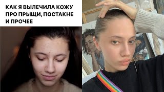 КАК Я ИЗБАВИЛАСЬ ОТ ПРЫЩЕЙ? Мой УХОД за кожей + советы