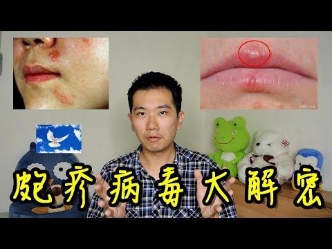 嘴唇上長皰疹是怎麼回事? 能預防嗎? 單純皰疹大解密! | 三分鐘聊醫學EP22