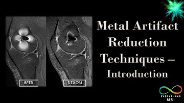 Metal Artifact Reduction Techniques - Introduction