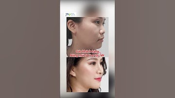 Nâng Mũi 100% bằng sụn sườn tự thân được không ? #shorts #benhvienjw #bacsitudung