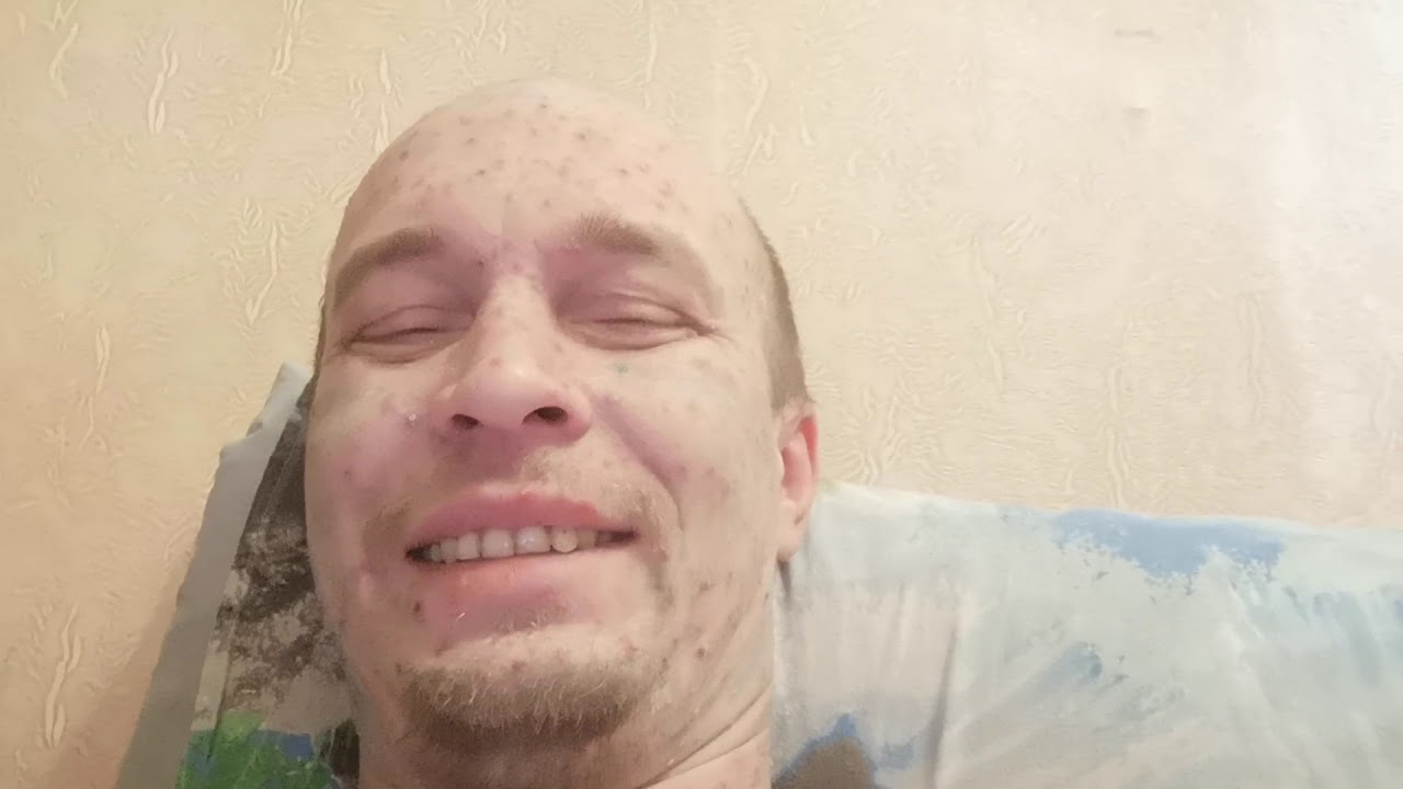 Ветрянка у взрослых - YouTube