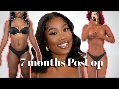 7 MONTH POST OP - I GOT MORE WORK DONE?! WHAT I'VE DONE TO MAINTAIN MY BODY... THE FINAL UPDATE!