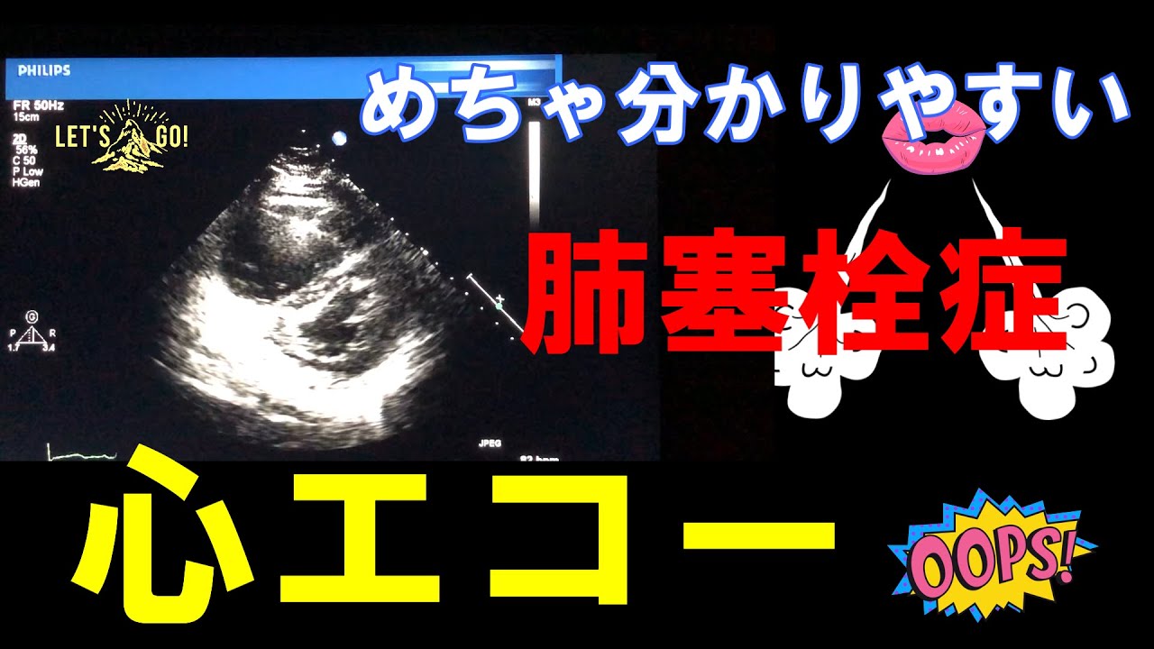 【肺塞栓症 心エコー 図検査】D-shape マッコーネル徴候　わかりやすく話します(^^)/
