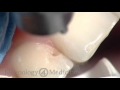 Class III Restoration w/ Technology4Medicine Dental Laser